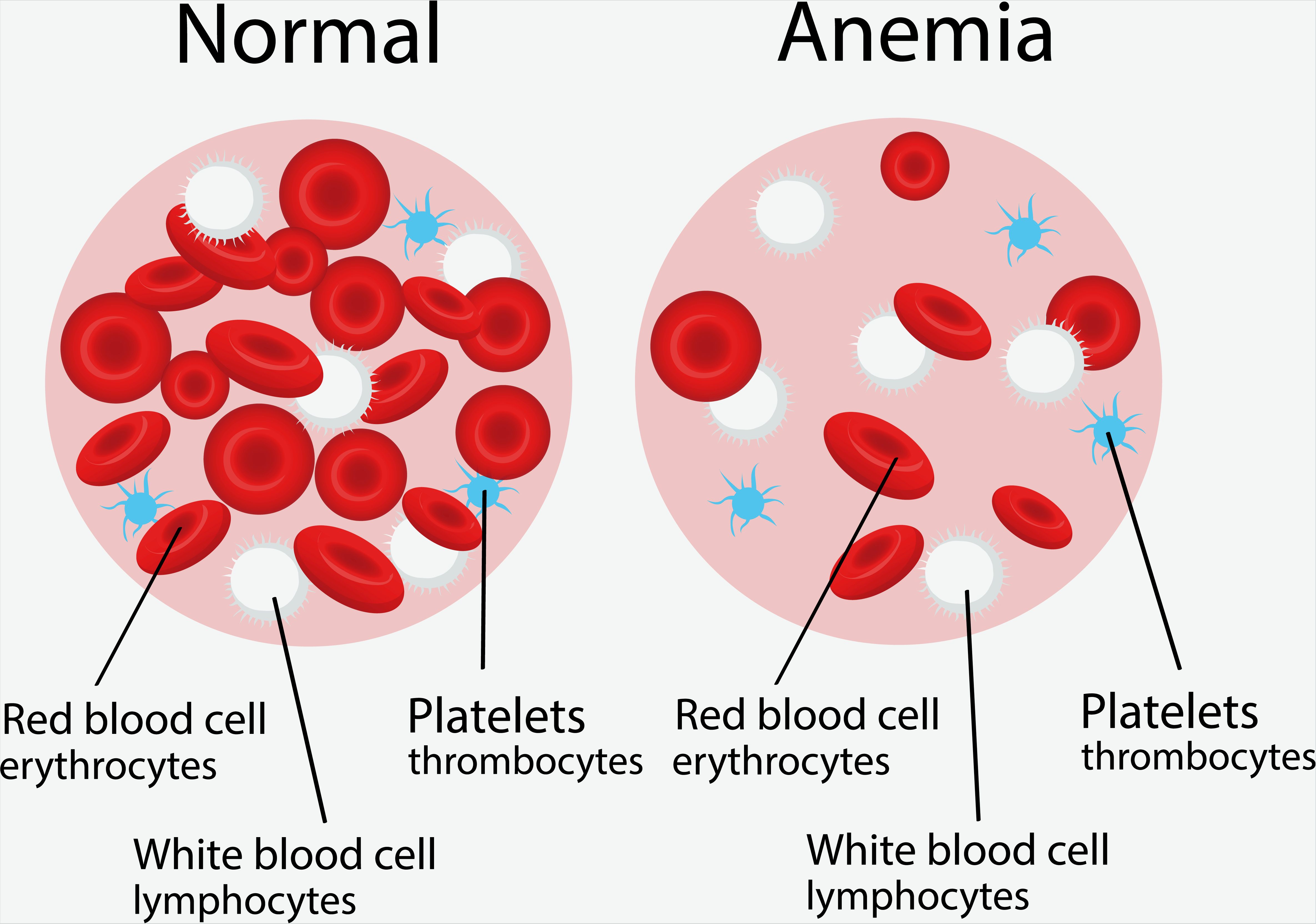 Es bueno andar para la anemia