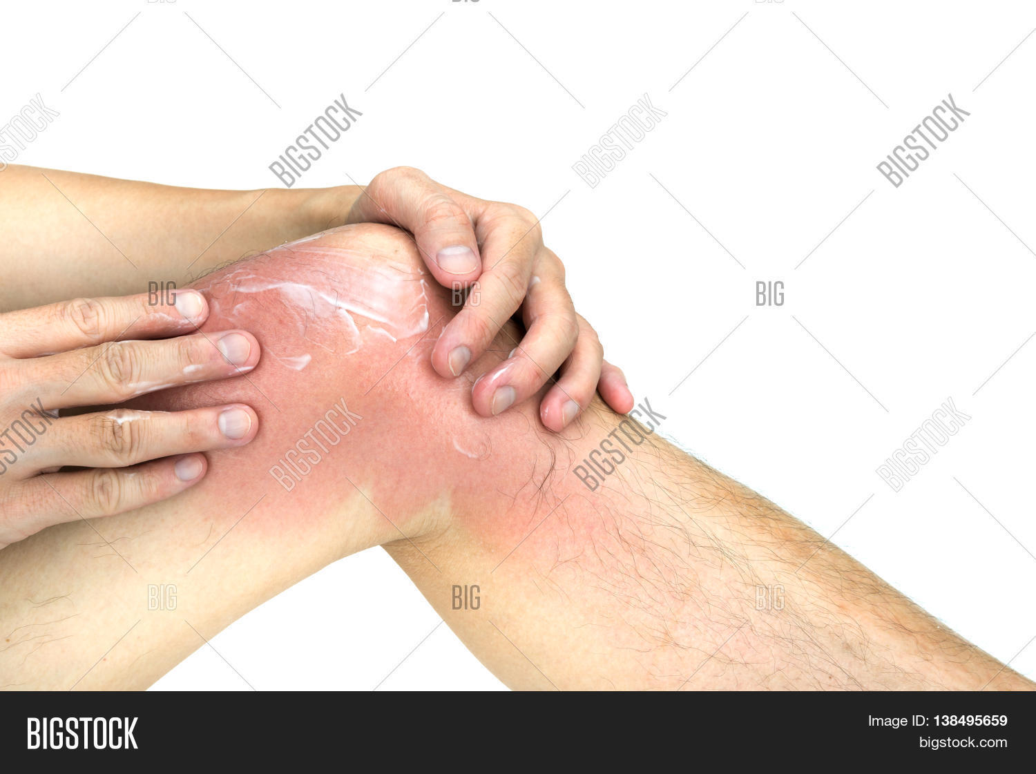 Заболевания кожи на коленях