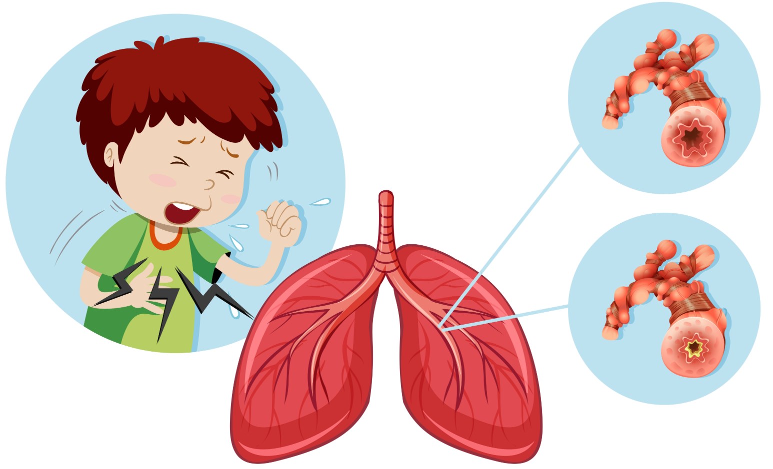 Синдром обструкции дыхательных путей у детей