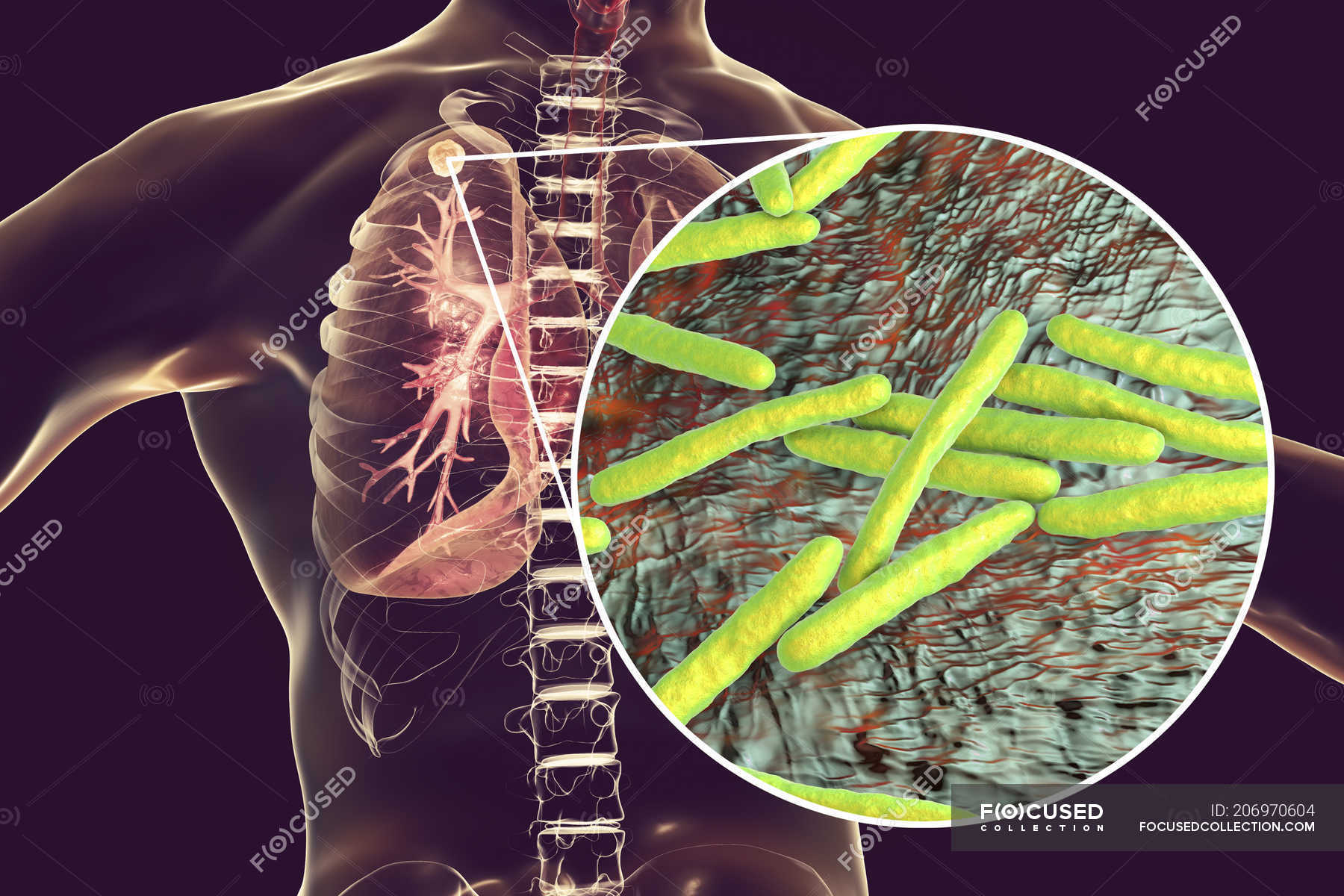 Микобактерии туберкулеза в легких
